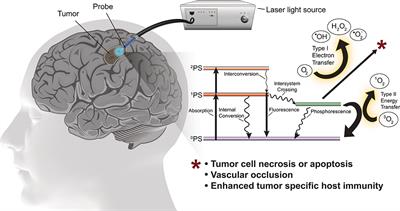 Photodynamic Therapy for the Treatment of Glioblastoma